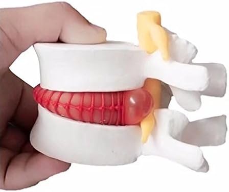 Lumbar Disc Herniation Spine Model - Anatomical Human Intervertebral Disc, 1.5X Magnification for School Teaching, Lab