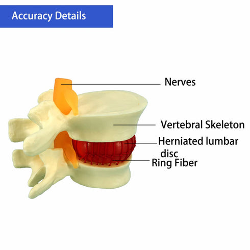 Human Anatomical Lumbar Disc Herniation Model, 1.5 Times Life Size for Teaching and Learning