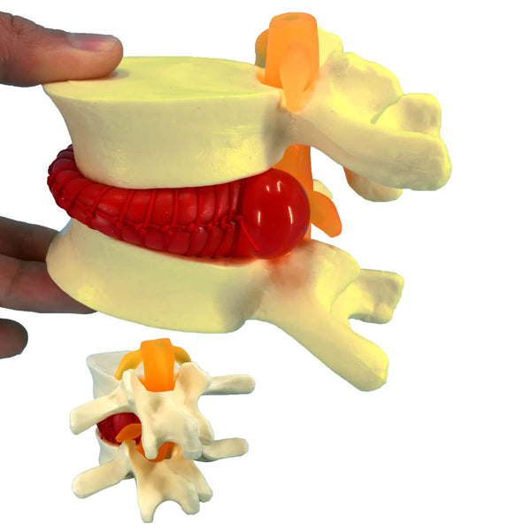 Human Anatomical Lumbar Disc Herniation Model, 1.5 Times Life Size for Teaching and Learning