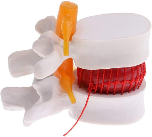 Lumbar Disc Herniation Spine Model - Magnification 1.5X Anatomical Human Lumbar Herniation Intervertebral Disc for School Teaching, Demonstrating, Lab Supplies