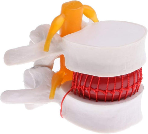 Lumbar Disc Herniation Spine Model - Anatomical Human Intervertebral Disc, 1.5X Magnification for School Teaching, Lab