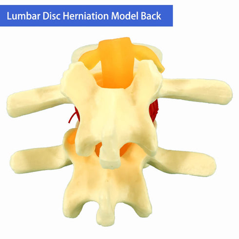 Human Anatomical Lumbar Disc Herniation Model, 1.5 Times Life Size for Teaching and Learning