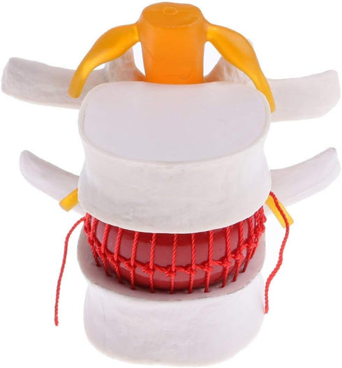 Lumbar Disc Herniation Spine Model - Anatomical Human Intervertebral Disc, 1.5X Magnification for School Teaching, Lab