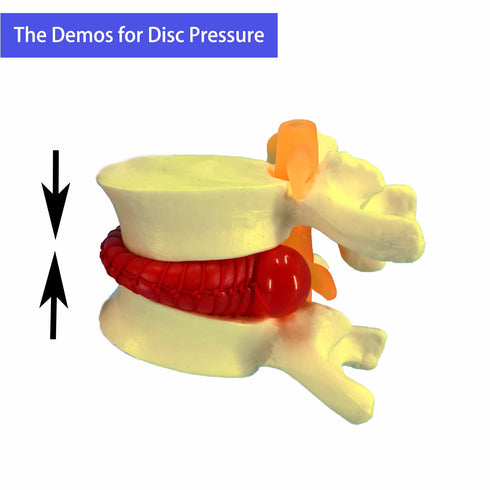 Human Anatomical Lumbar Disc Herniation Model, 1.5 Times Life Size Lumbar Disc Herniation Model, Human Lumbar Disc Herniation Model for Teaching, Learning, Demonstrating