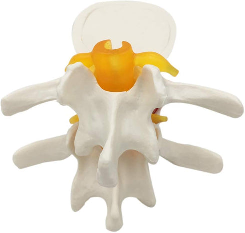 Lumbar Disc Herniation Spine Model - Anatomical Human Intervertebral Disc, 1.5X Magnification for School Teaching, Lab