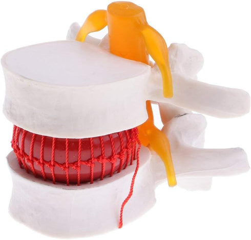 Lumbar Disc Herniation Spine Model - Anatomical Human Intervertebral Disc, 1.5X Magnification for School Teaching, Lab