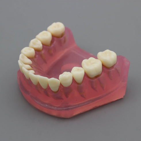 Smile1000 Dental Implant Teeth Model with Removable Teeth for Dental Professionals and Students
