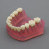 Smile1000 Dental Implant Teeth Model with Removable Teeth for Dental Professionals and Students
