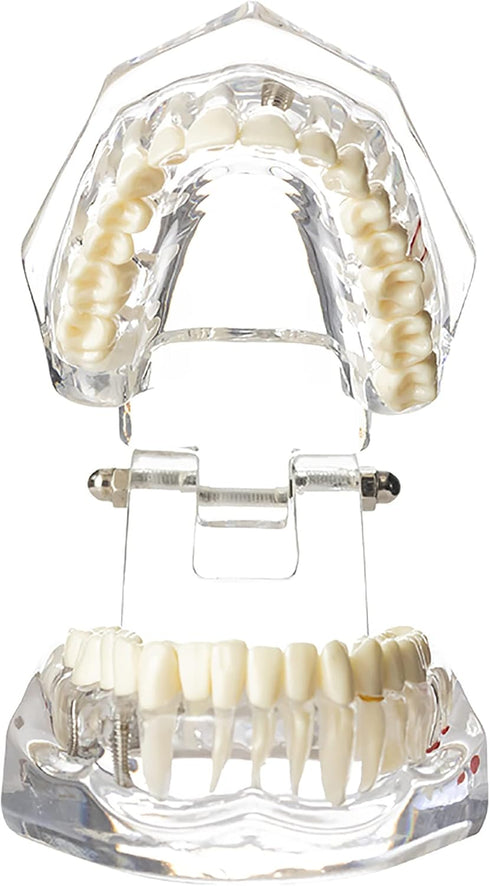 Dental Oral Typodont Model, Implant Pathological Removable Teaching Demo, Standard Size (Clear)