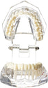 Dental Oral Typodont Model, Implant Pathological Removable Teaching Demo, Standard Size (Clear)
