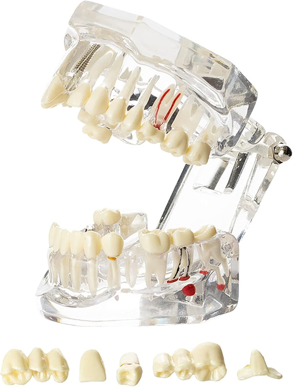 Dental Oral Typodont Model, Implant Pathological Removable Teaching Demo, Standard Size (Clear)