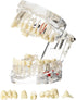 Dental Oral Typodont Model, Implant Pathological Removable Teaching Demo, Standard Size (Clear)