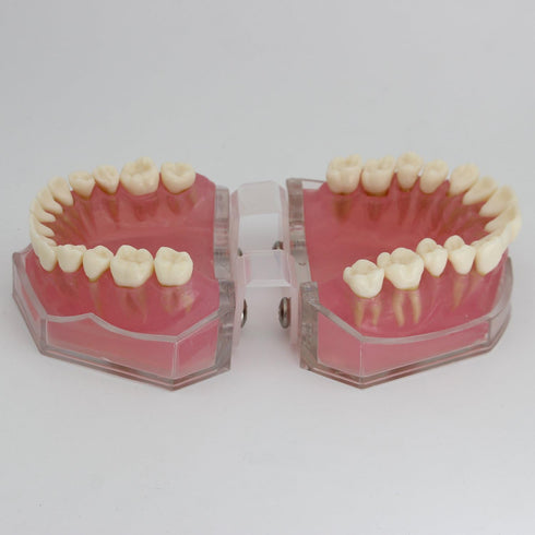 Smile1000 Dental Implant Teeth Model with Removable Teeth for Dental Professionals and Students