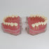 Smile1000 Dental Implant Teeth Model with Removable Teeth for Dental Professionals and Students