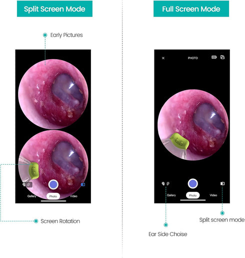 Wireless Otoscope Ear Camera with Dual View, 3.9mm 720PHD WiFi Ear Scope for Kids and Adults, Compatible with Android