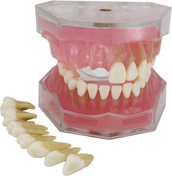 Smile1000 Dental Implant Teeth Model with Removable Teeth for Dental Professionals and Students