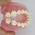 Smile1000 Dental Implant Teeth Model with Removable Teeth for Dental Professionals and Students