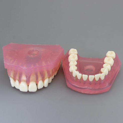 Smile1000 Dental Implant Teeth Model with Removable Teeth for Dental Professionals and Students