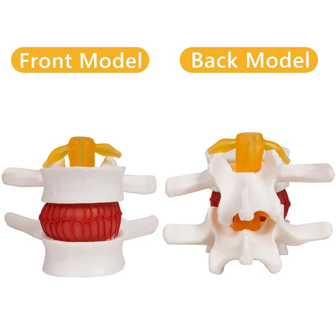 Model:1.5 breesky Human Anatomical Lumbar Disc Herniation Times Life Size Lumbar Disc Teaching Model Tool-for Medical
