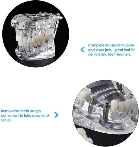 Dental Oral Typodont Model, Implant Pathological Removable Teaching Demo, Standard Size (Clear)