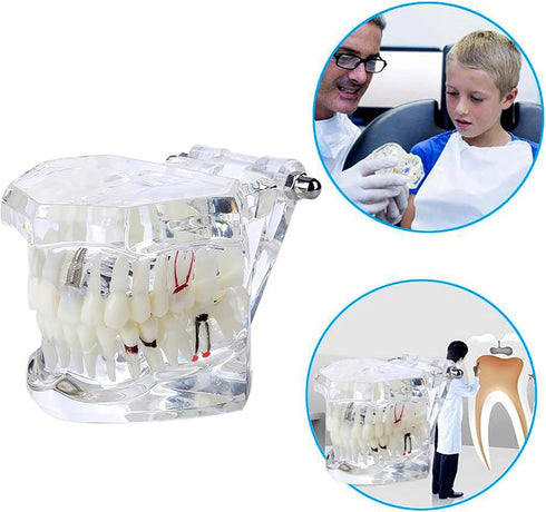 Dental Oral Typodont Model, Implant Pathological Removable Teaching Demo, Standard Size (Clear)