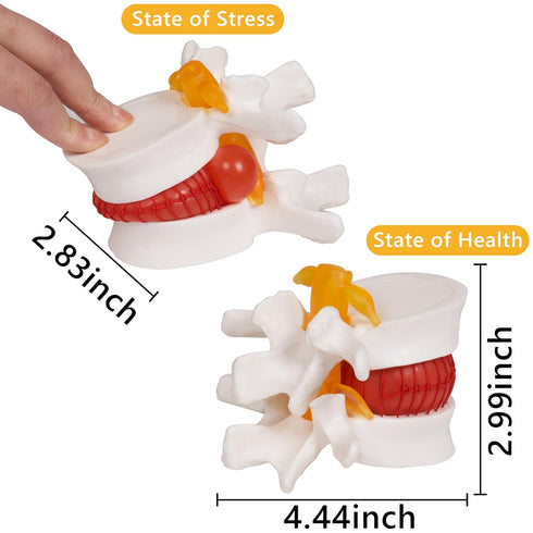 Model:1.5 breesky Human Anatomical Lumbar Disc Herniation Times Life Size Lumbar Disc Teaching Model Tool-for Medical