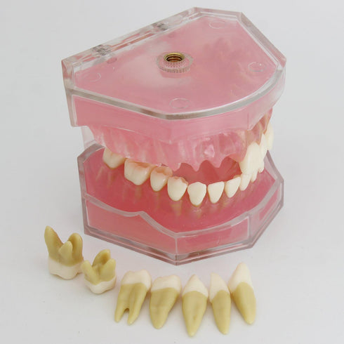 Smile1000 Dental Implant Teeth Model with Removable Teeth for Dental Professionals and Students