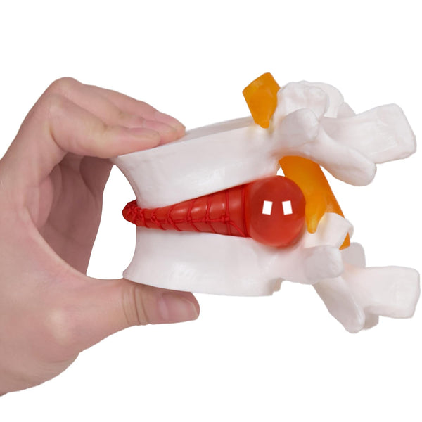 breesky Human Anatomical Lumbar Disc Herniation Model:1.5 Times Life Size Lumbar Disc