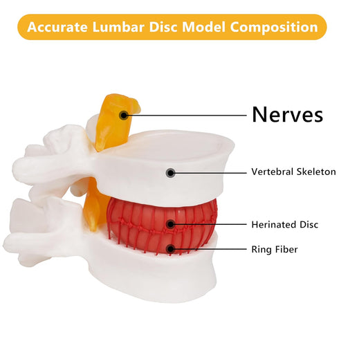 Model:1.5 breesky Human Anatomical Lumbar Disc Herniation Times Life Size Lumbar Disc Teaching Model Tool-for Medical