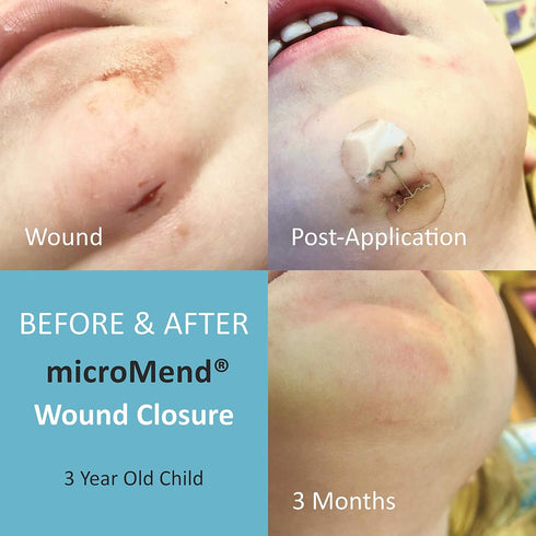 (2 1 1 Emergency Wound Closures Surgical Quality Laceration Repair Without Stitches - Think Ahead - Be Prepared