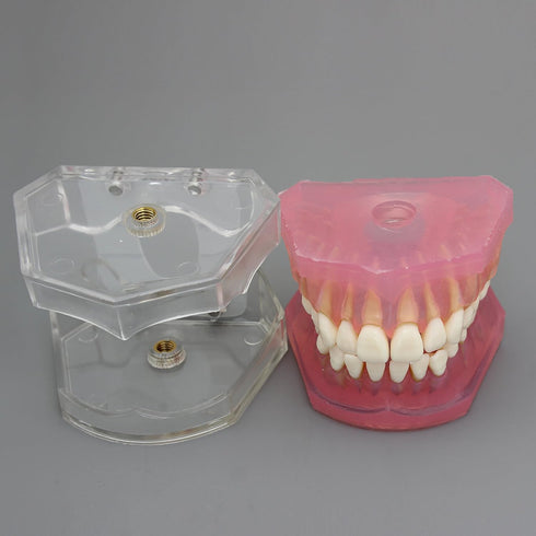 Smile1000 Dental Implant Teeth Model with Removable Teeth for Dental Professionals and Students
