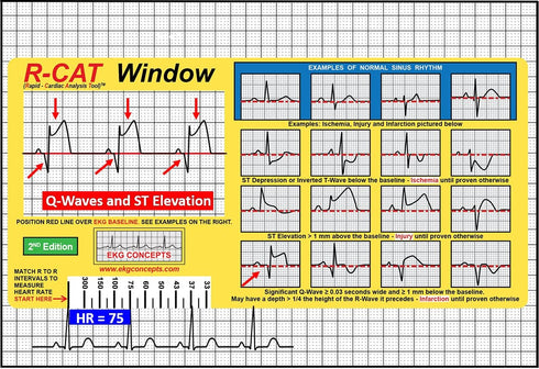R-CAT EKG Window, 2nd Edition