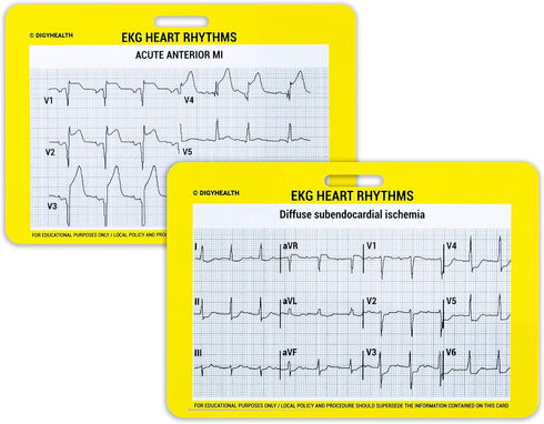 EKG 5 Card Set - Common Cardiac Rhythms Lead Placement Telemetry Cards for Nurses, EMTs, and Medical Students